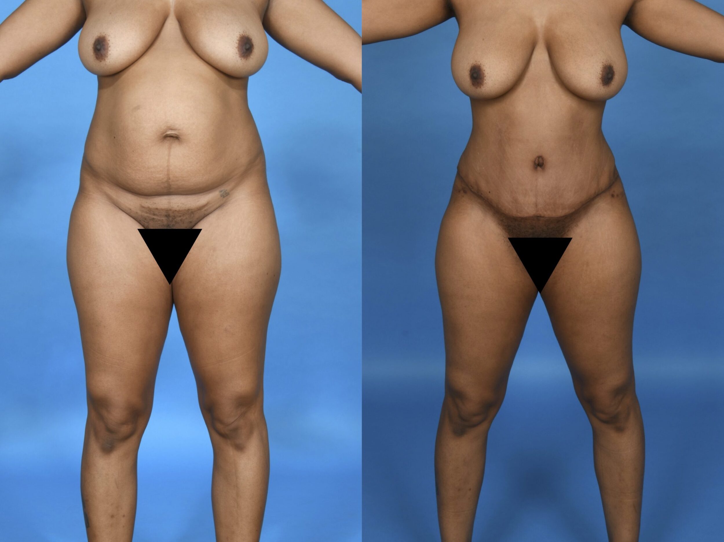 Before and After Image: Abdominoplasty with Liposuction of the Flanks and Abdomen - front