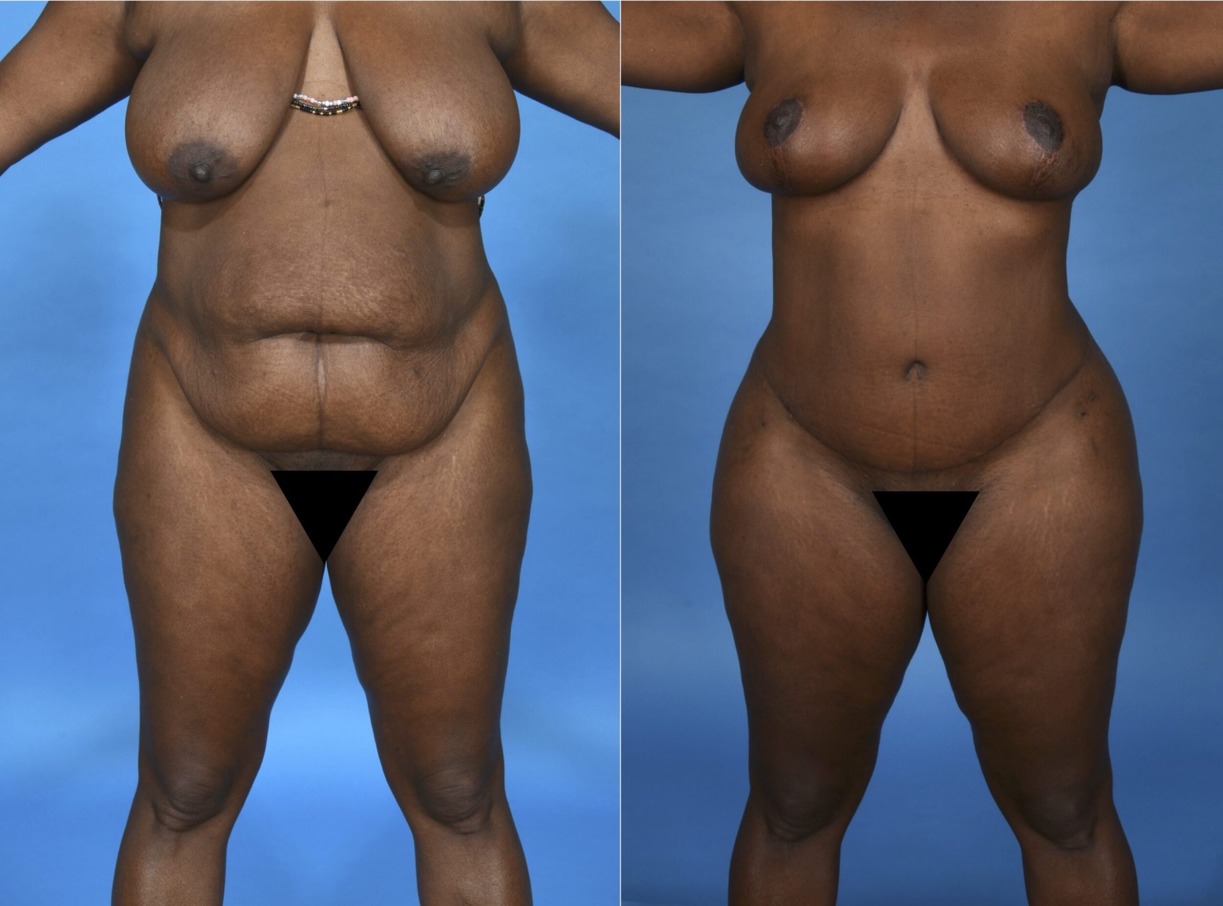 Before and After Image: Extended Abdominoplasty, 360° Liposuction, and an Extended Mastopexy - front