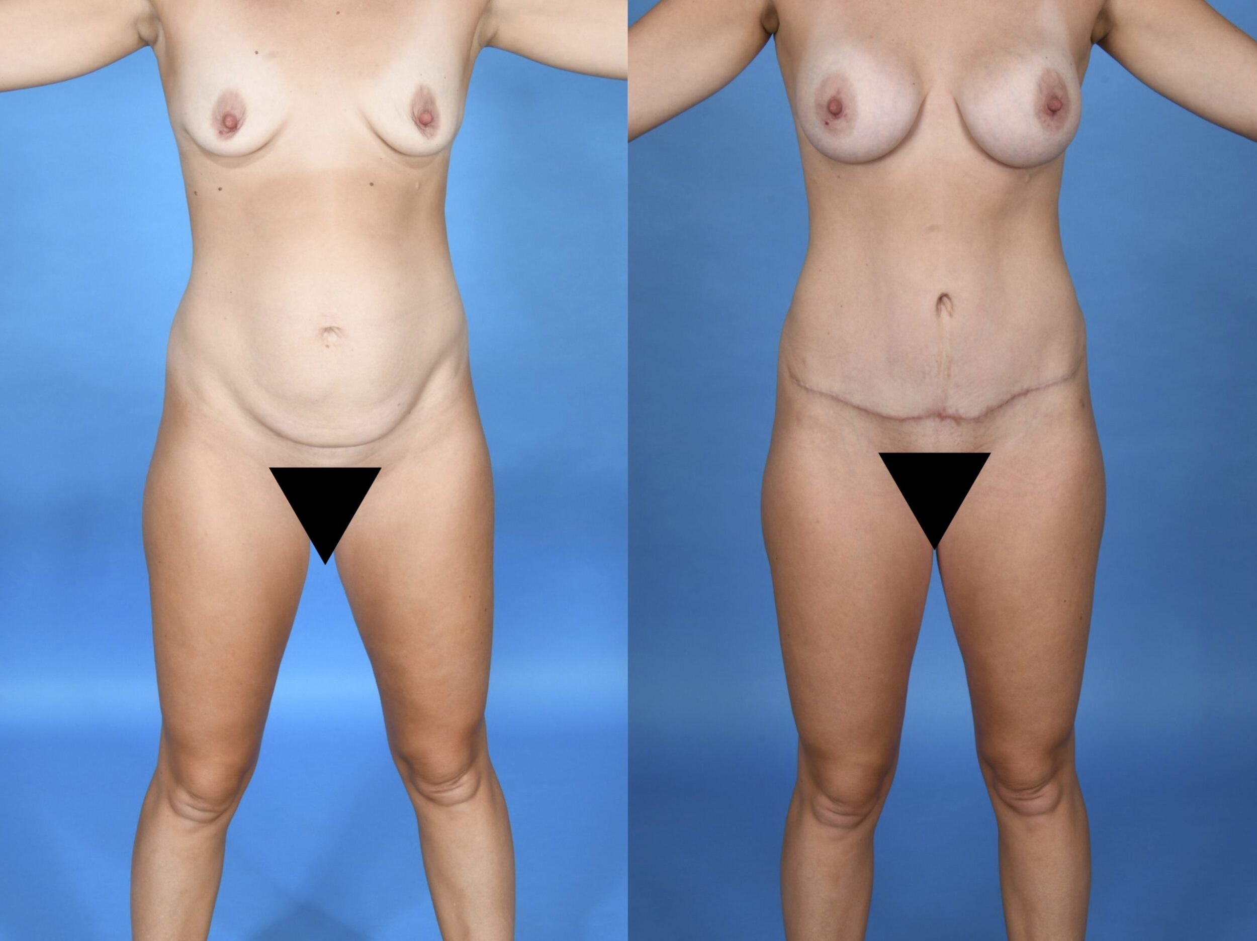Before and After Image: Abdominoplasty with Liposuction and Breast Augmentation - front