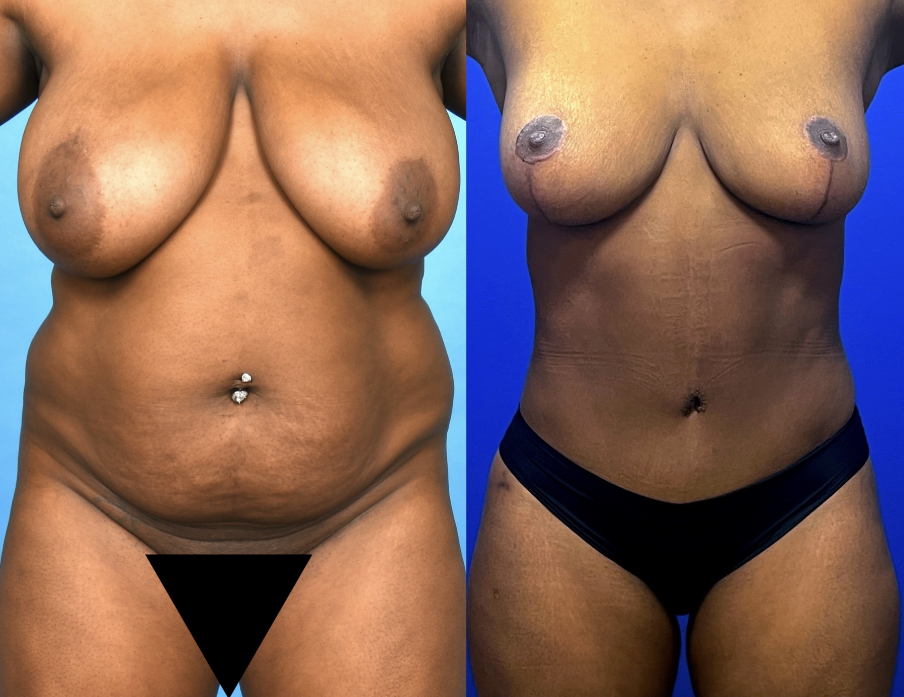 Before and After Image: Two-stage Extended Abdominoplasty, 360 Degree Liposuction, Bilateral Breast Reduction And Buttock Fat Grafting - front