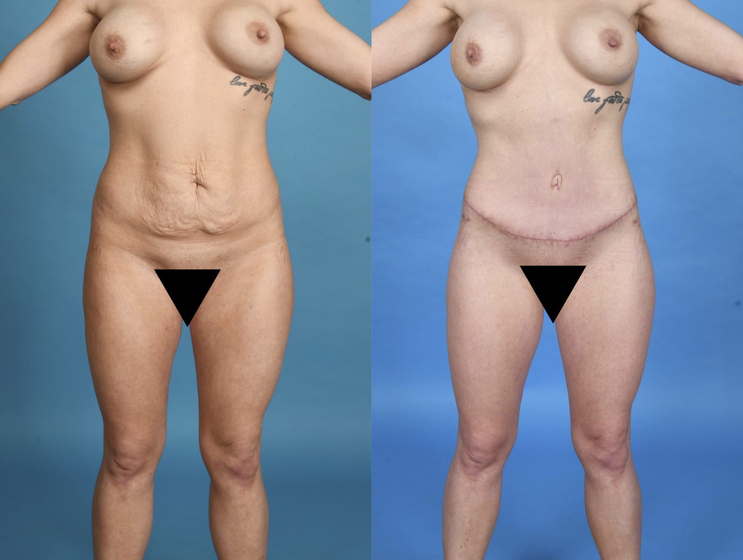 Before and After Image: Extended Abdominoplasty with Lower Back and Flank Liposuction - front