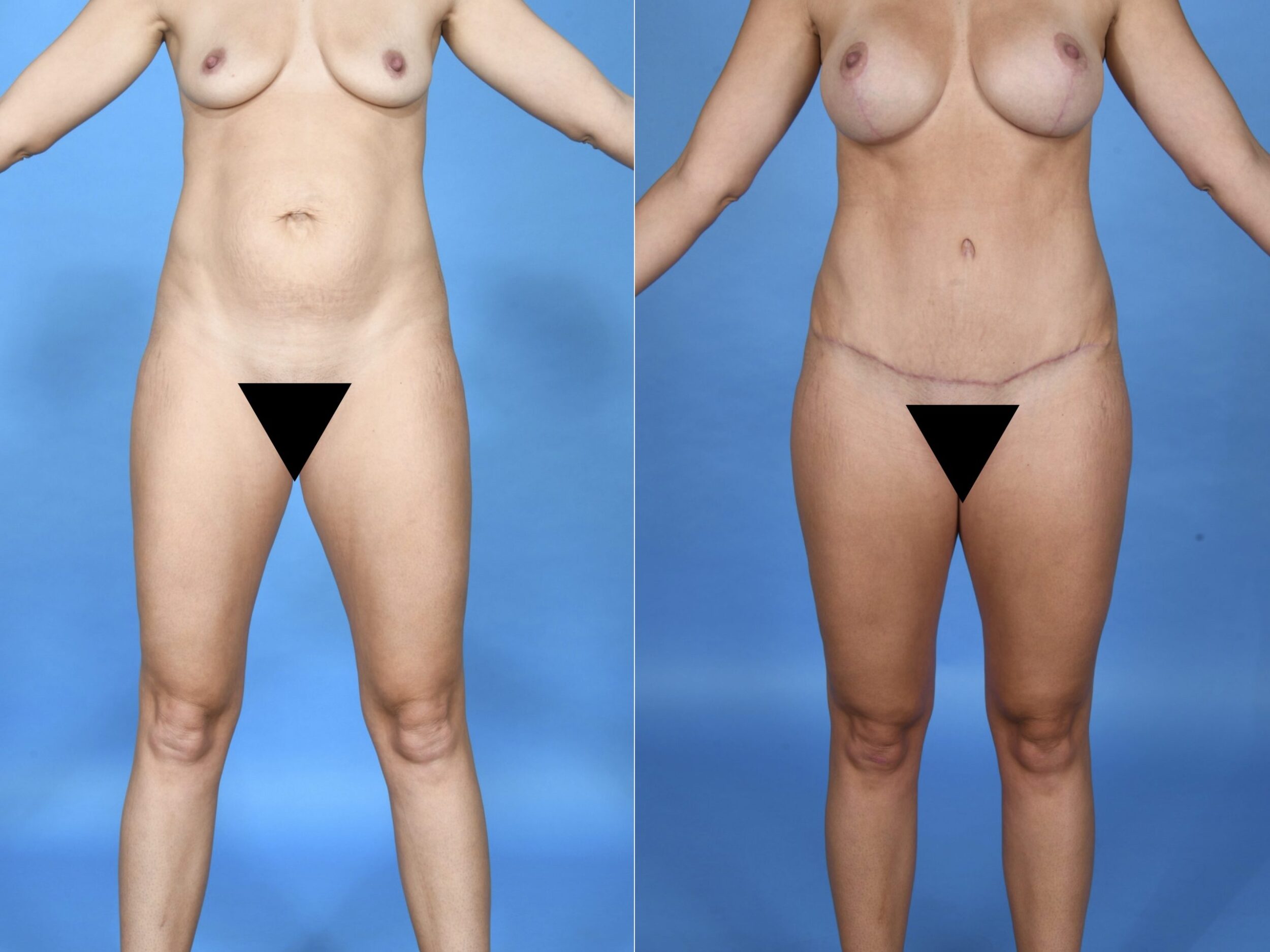 Before and After Image: Abdominoplasty with Liposuction and Breast Augmentation/mastopexy - front