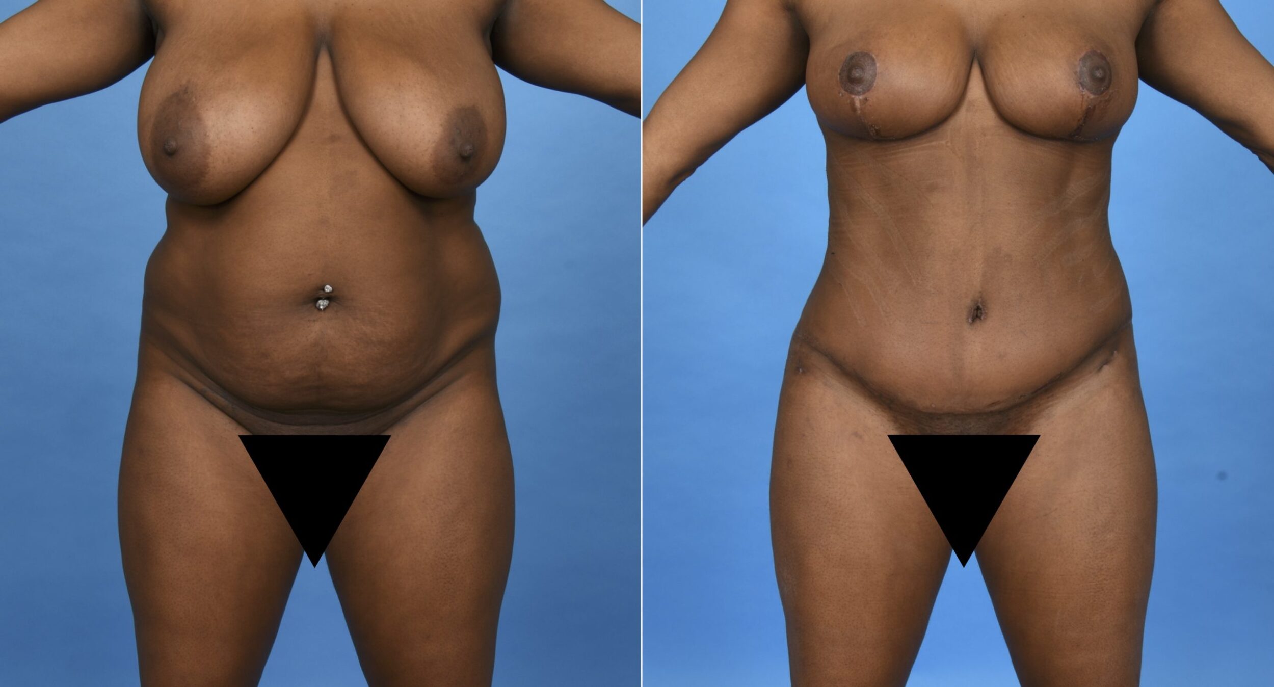 Before and After Image: Extended Abdominoplasty, 360 Degree Liposuction, Bilateral Breast Reduction - front