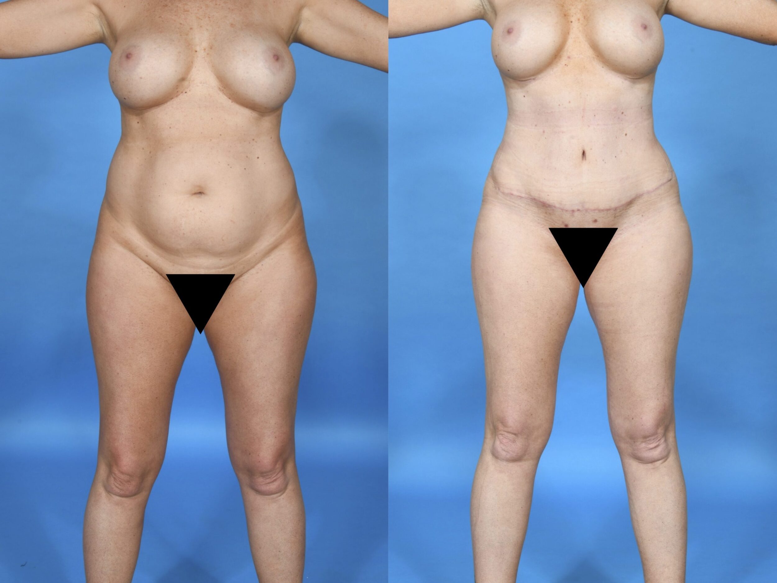 Before and After Image: Abdominoplasty with 360° Liposuction - front
