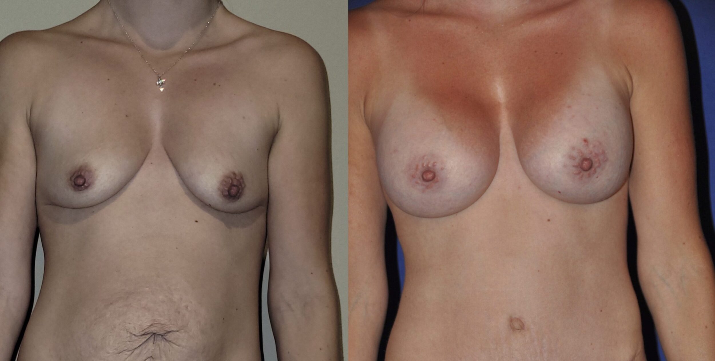 Before and After Image: Subfascial 385cc Breast Augmentation, Tummy Tuck, Flank Lipo & Umbilical Hernia Repair - front