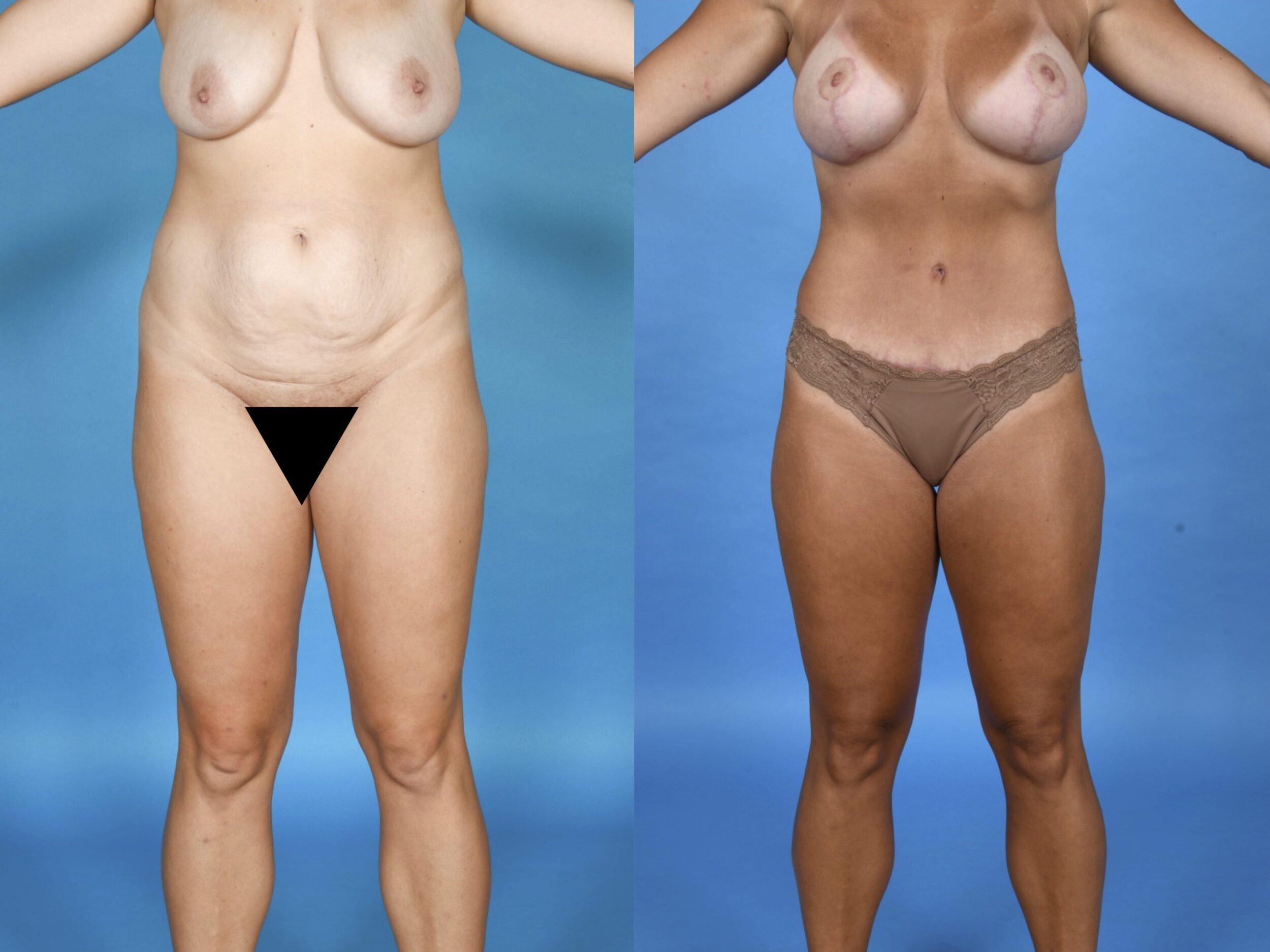 Before and After Image: Lipoabdominoplasty with Simultaneous Augmentation-Mastopexy (310cc) - front