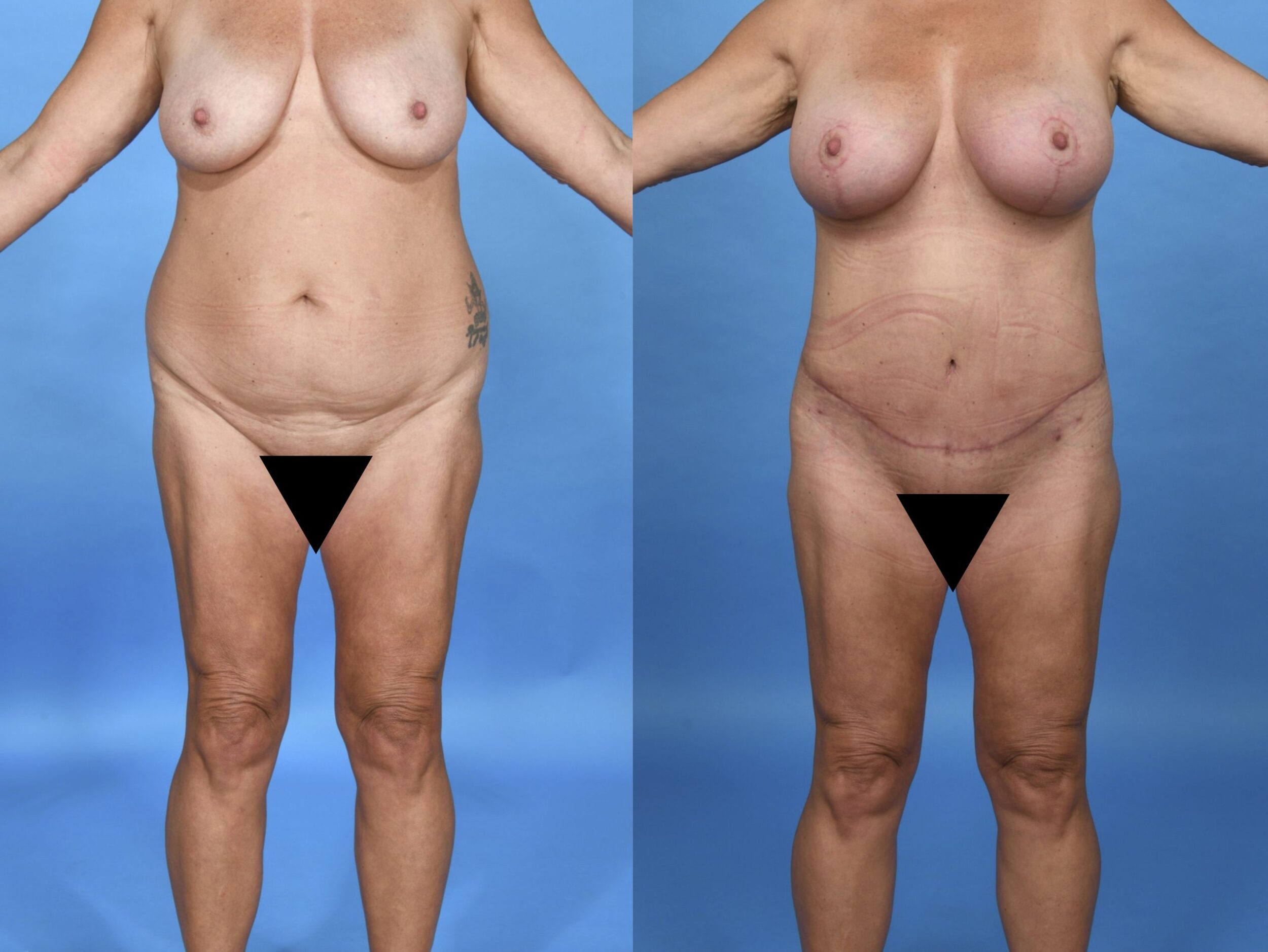 Before and After Image: Extended Abdominoplasty with 360° Liposuction and an Augmentation Mastopexy - front