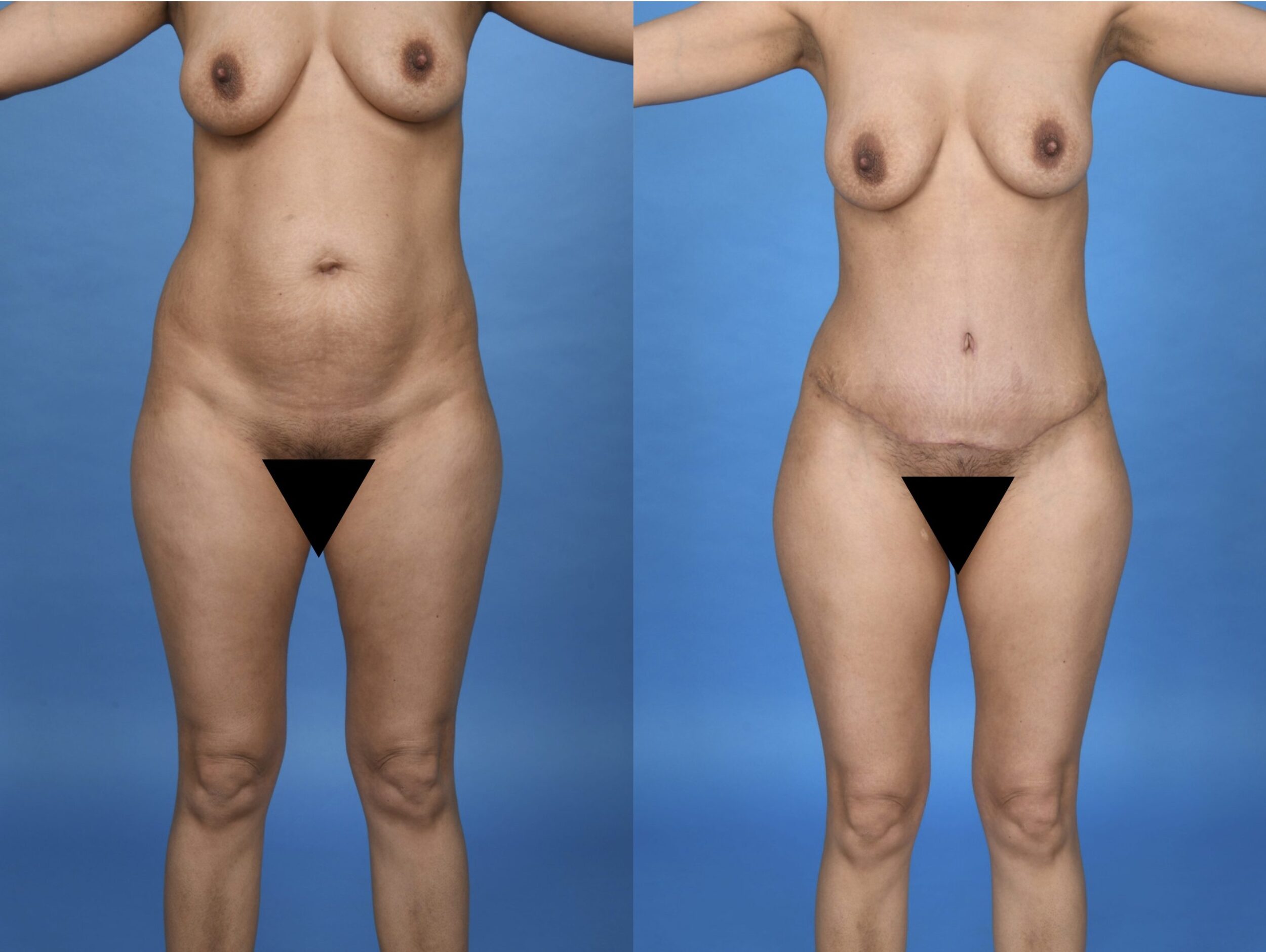 Before and After Image: Abdominoplasty and 360-degree Liposuction - front