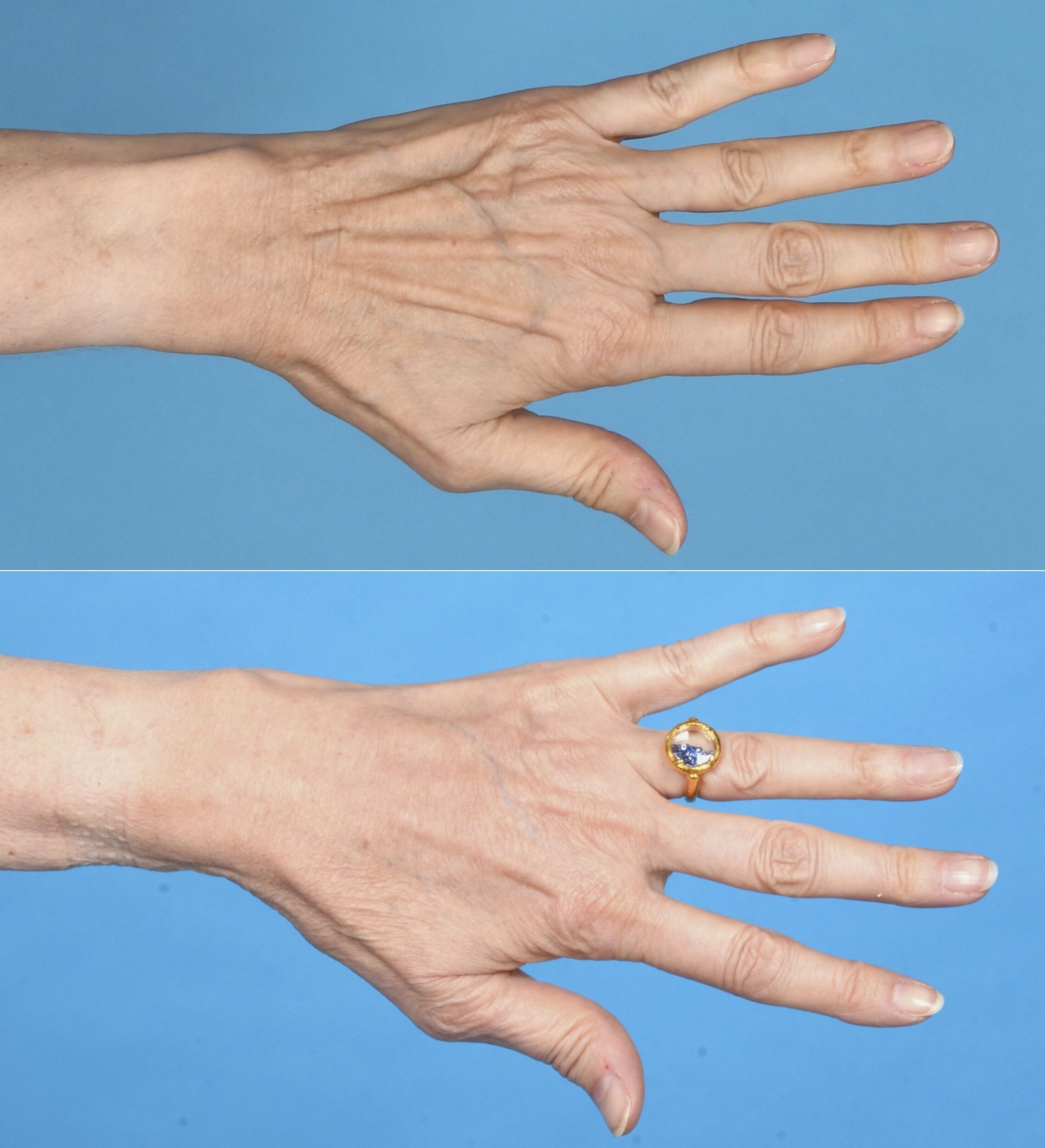 Before and After Image: Hand Rejuvenation - front