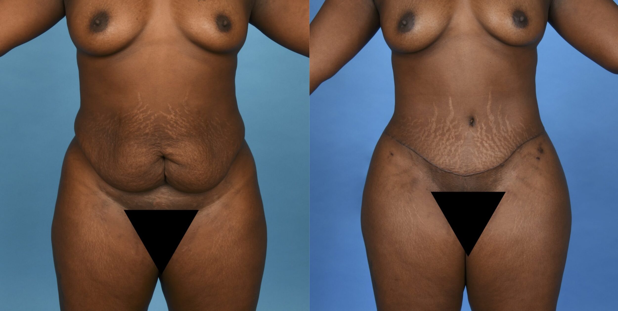 Before and After Image: Abdominoplasty with 360 Degree Liposuction - front