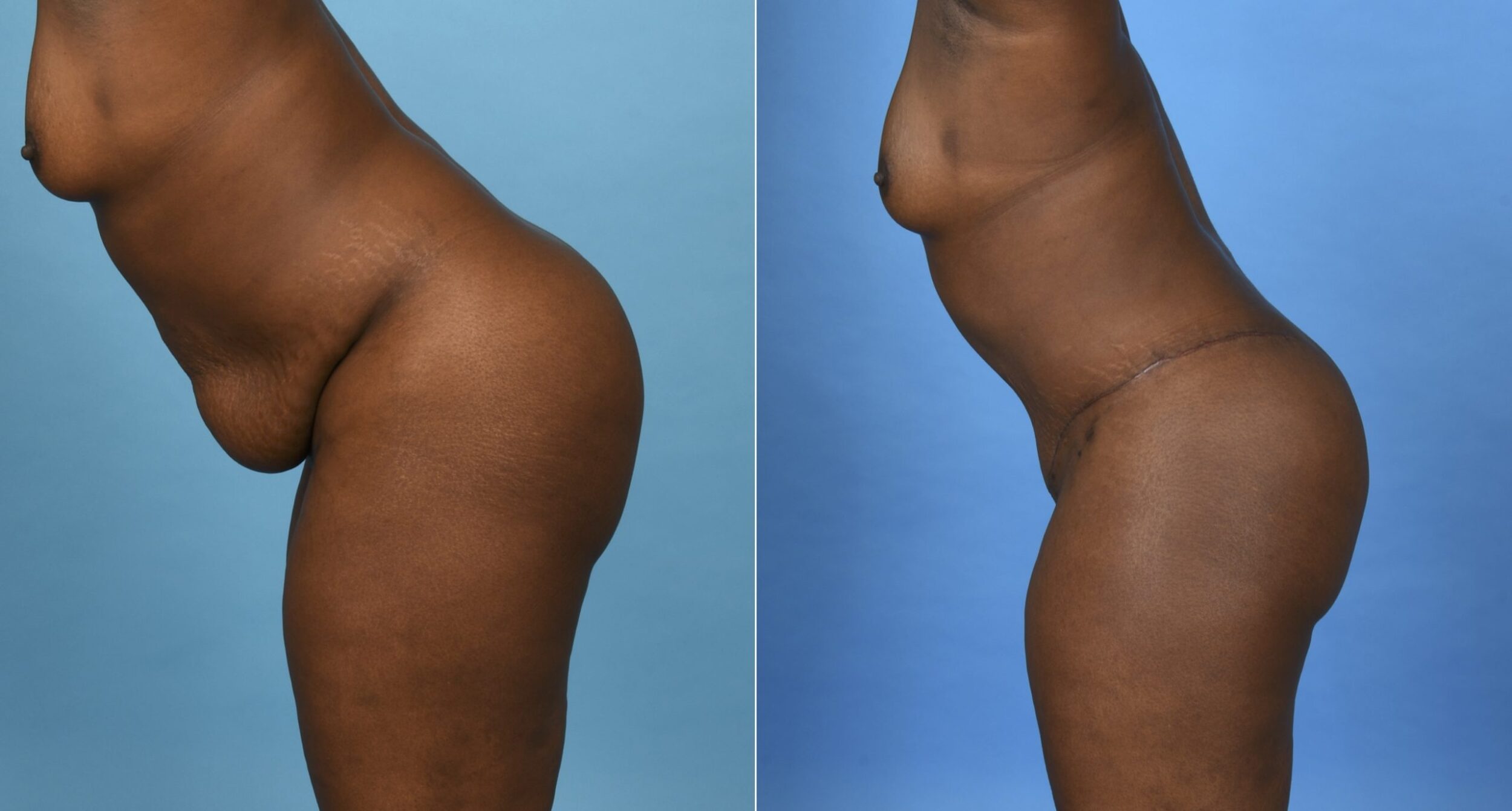 Before and After Image: Abdominoplasty with 360 Degree Liposuction - other