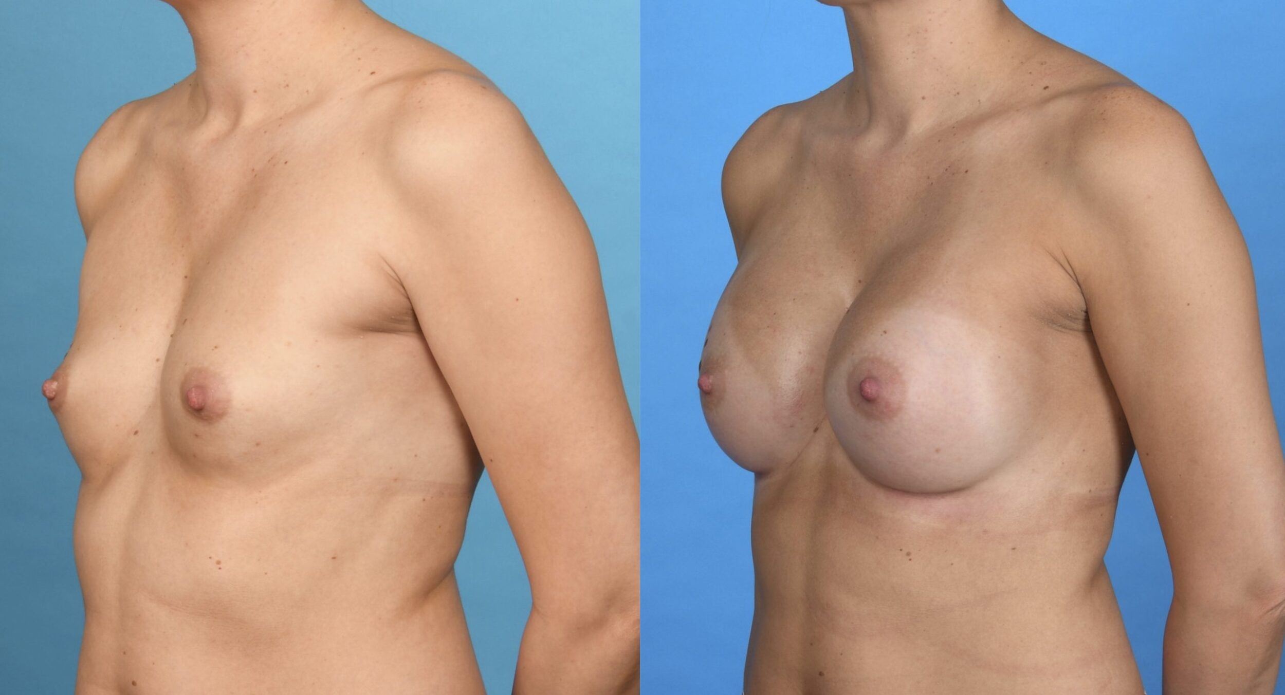 Before and After Image: Submuscular Silicone Breast Augmentation - left-front-oblique