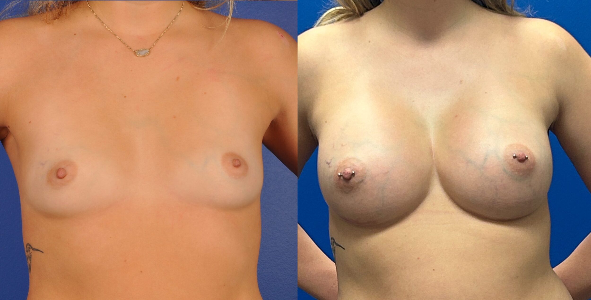 Before and After Image: Subfascial Silicone Breast Augmentation - front
