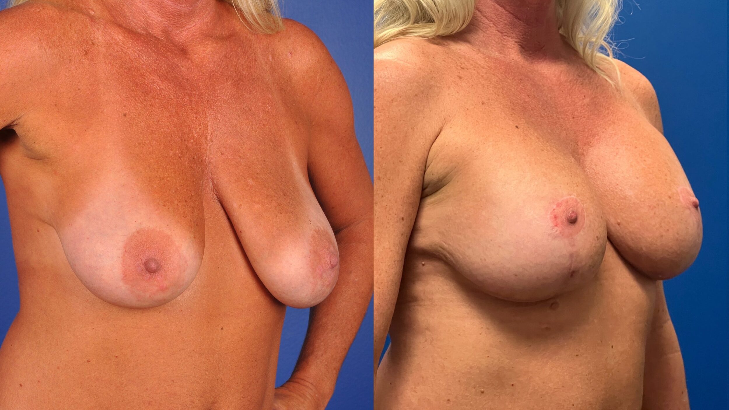 Before and After Image: Silicone Breast Augmentation Mastopexy - right-front-oblique