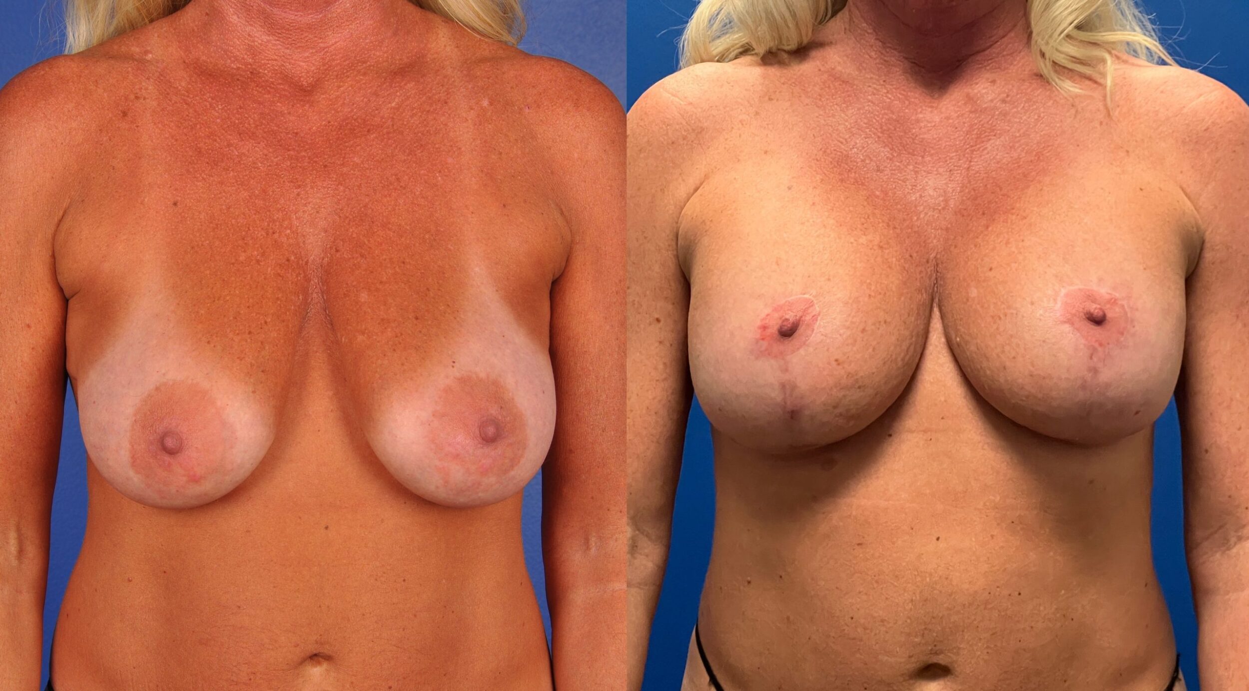 Before and After Image: Silicone Breast Augmentation Mastopexy - front