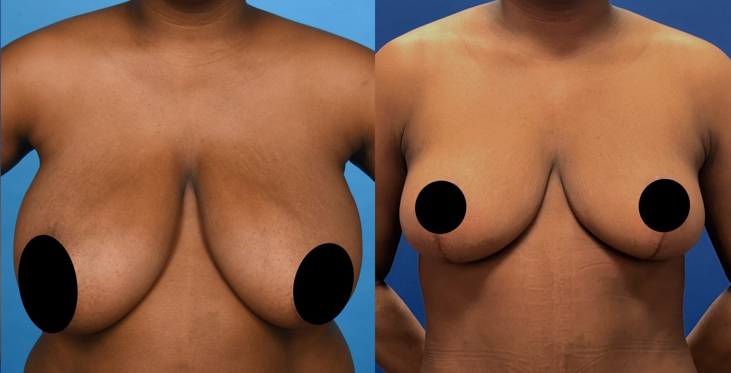 Before and After Image: Breast Reduction and Breast Lift - front
