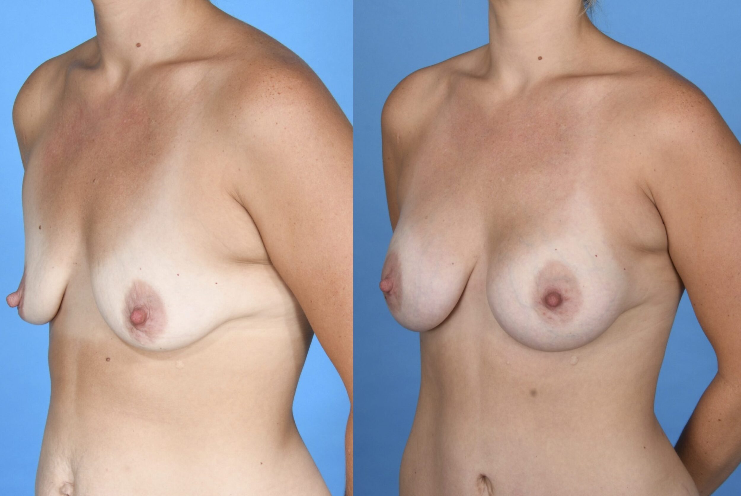 Before and After Image: Submuscular Silicone Breast Augmentation - left-front-oblique