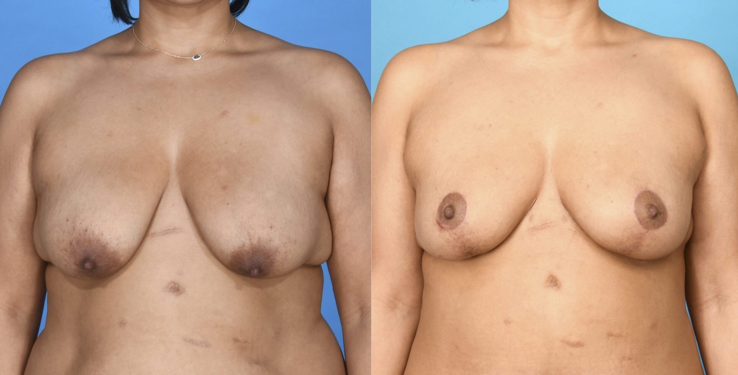 Before and After Image: Breast Lift (Mastopexy) - front