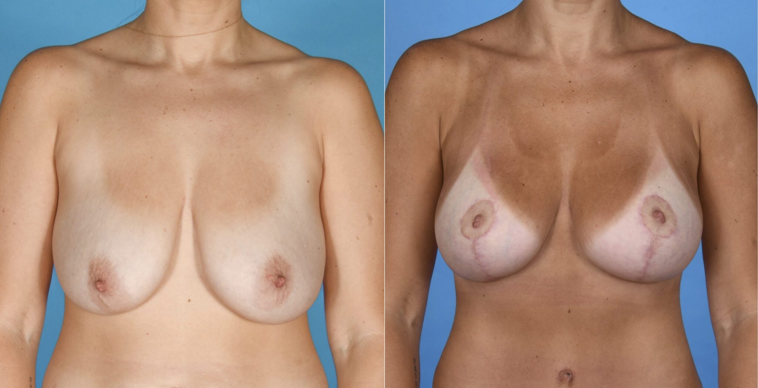 Before and After Image: Silicone Breast Augmentation with Mastopexy - front