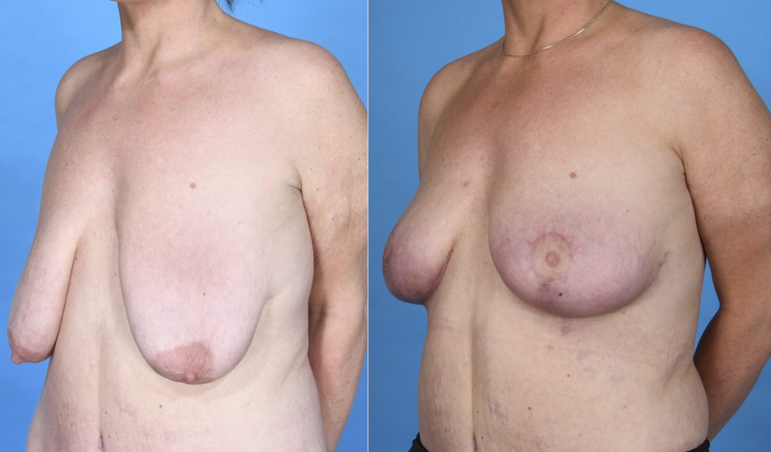 Before and After Image: Breast Lift (Mastopexy) - left-front-oblique