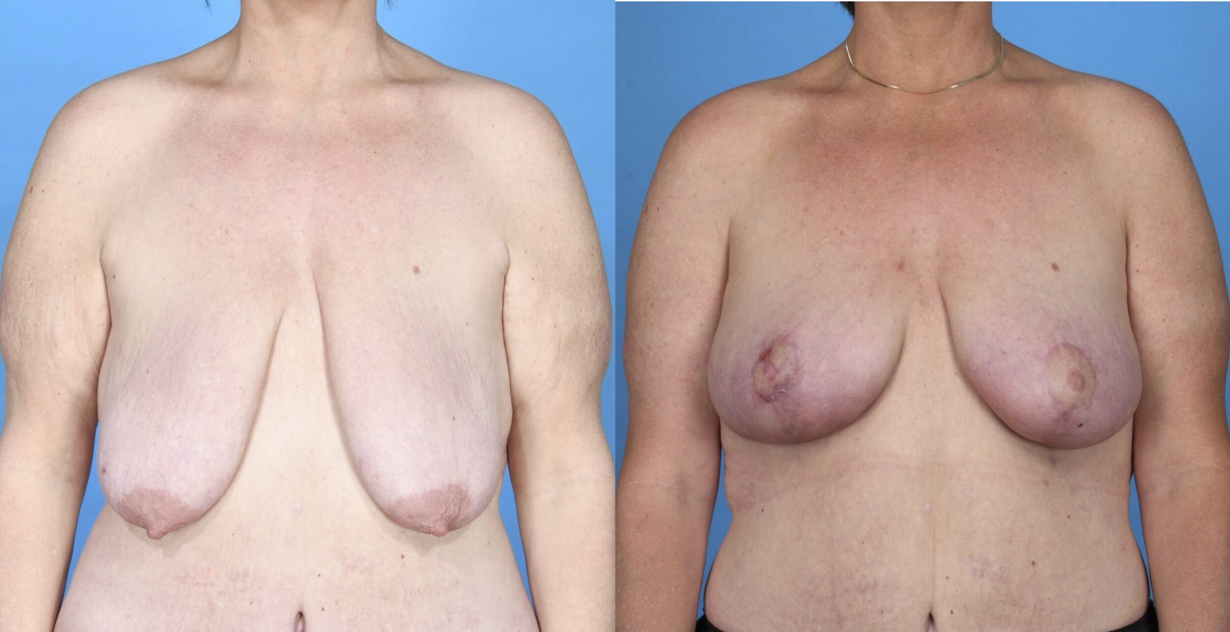 Before and After Image: Breast Lift (Mastopexy) - front