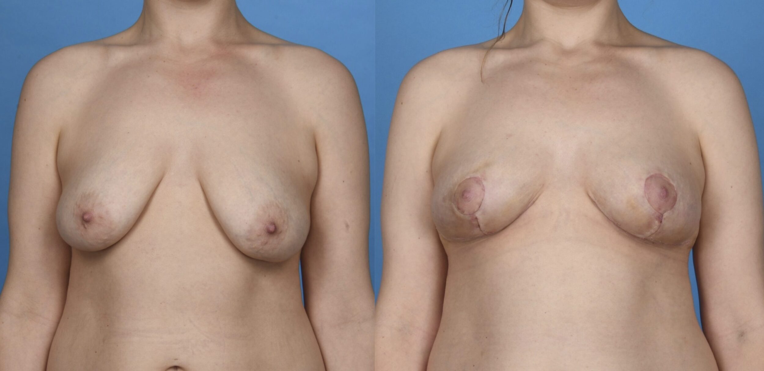 Before and After Image: Breast Lift (Mastopexy) - front