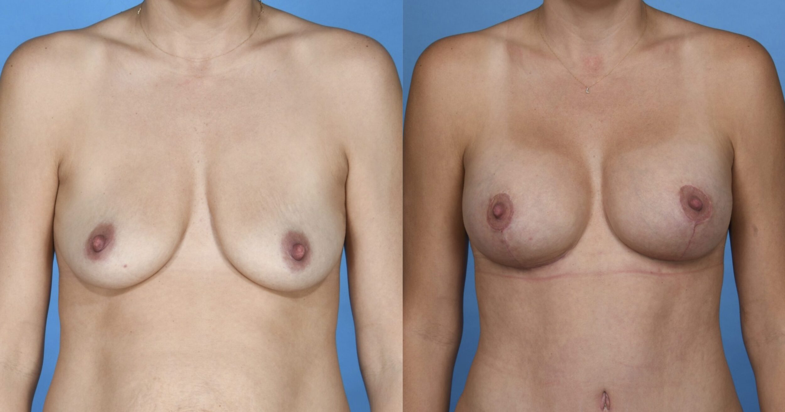 Before and After Image: Breast Augmentation Mastopexy - front