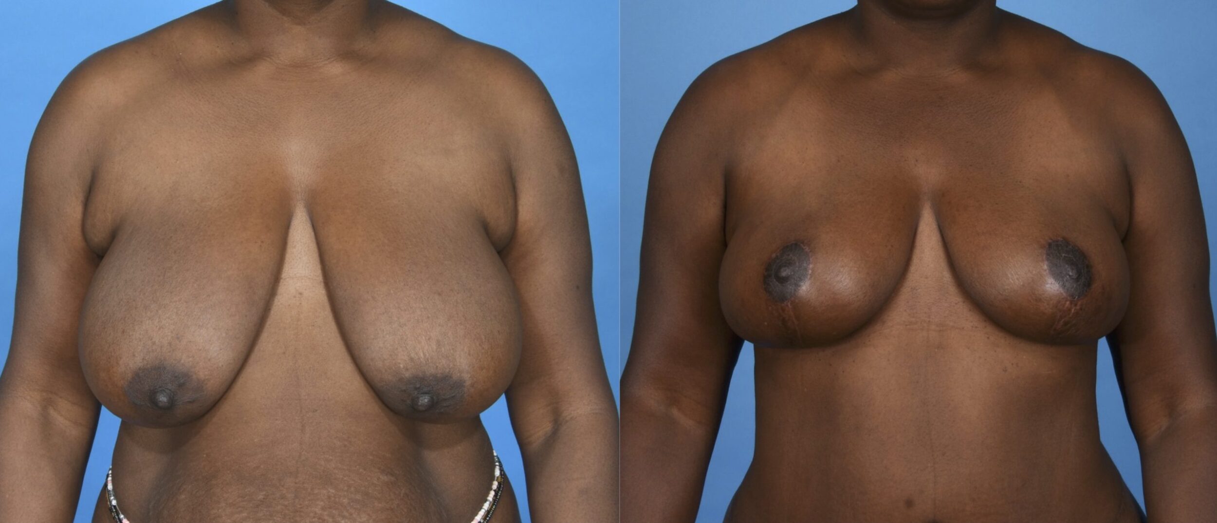 Before and After Image: Breast Reduction with Lift - front