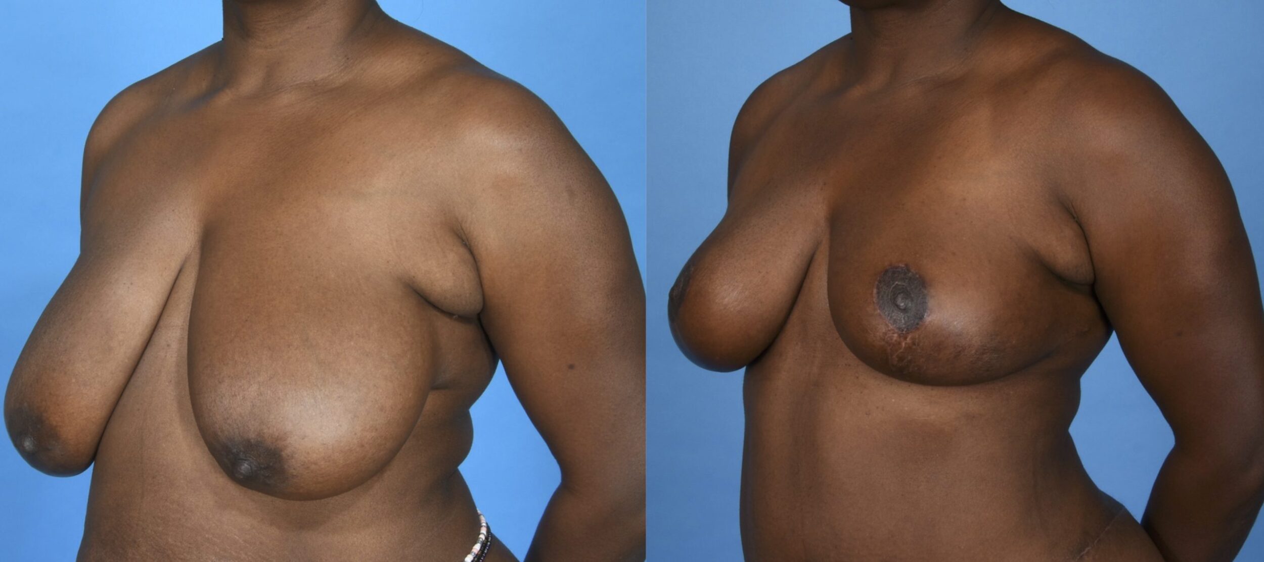 Before and After Image: Breast Reduction with Lift - left-front-oblique