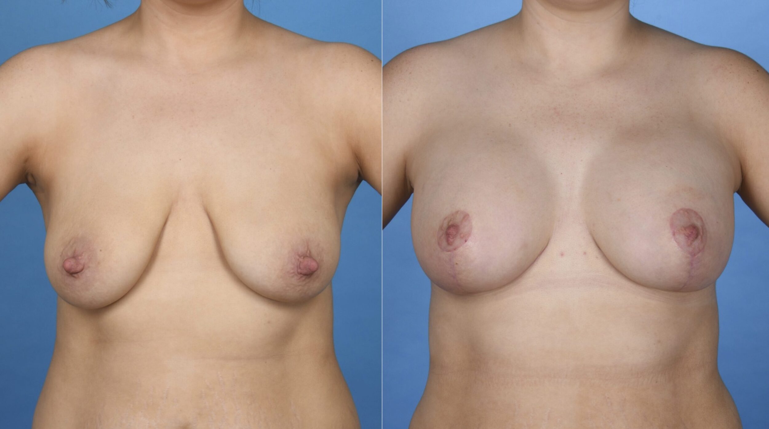 Before and After Image: Breast Augmentation Mastopexy with Nipple Reduction - front