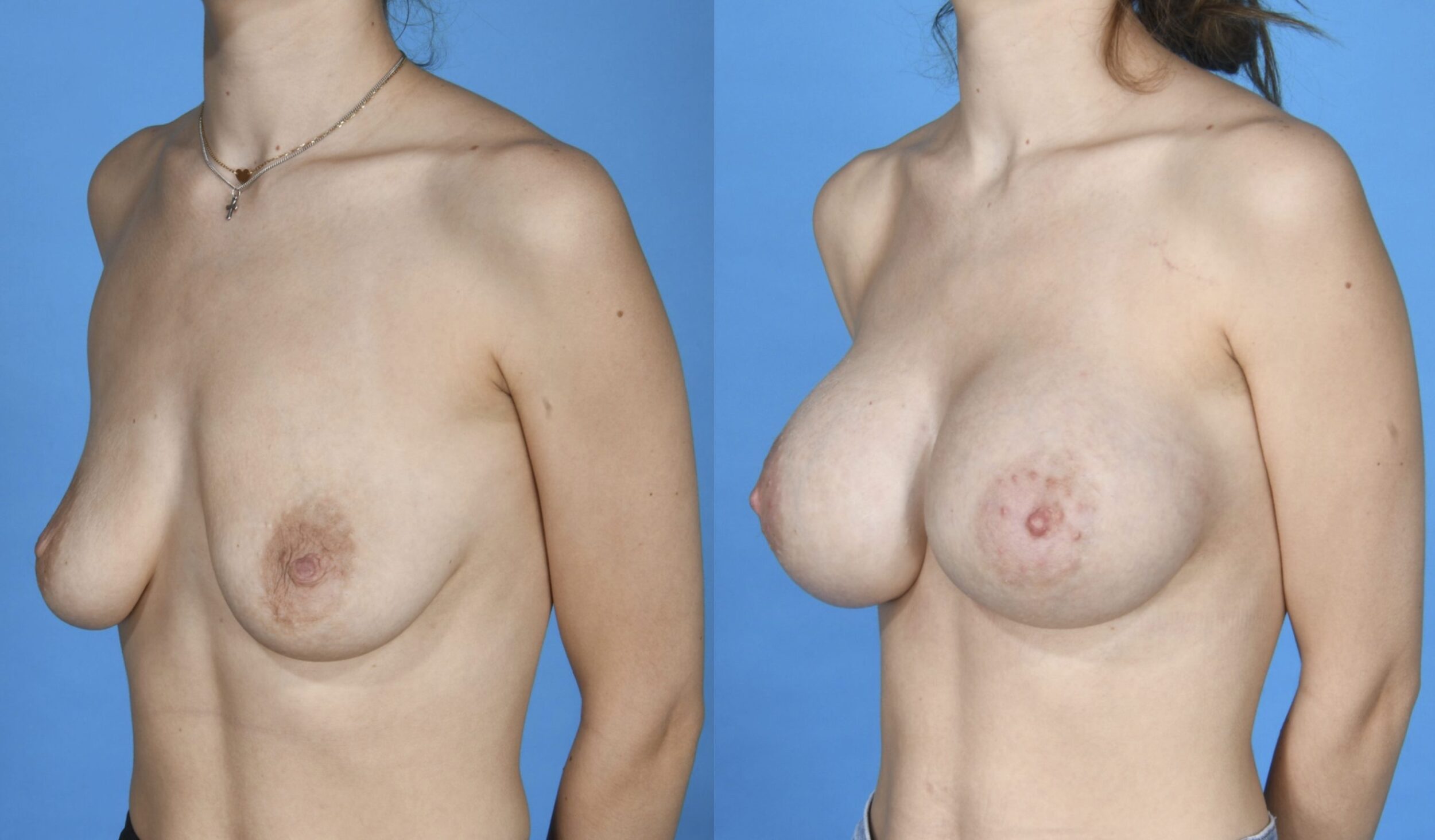 Before and After Image: Submuscular (Dual Plane/half under the muscle) Silicone Breast Augmentation - left-front-oblique