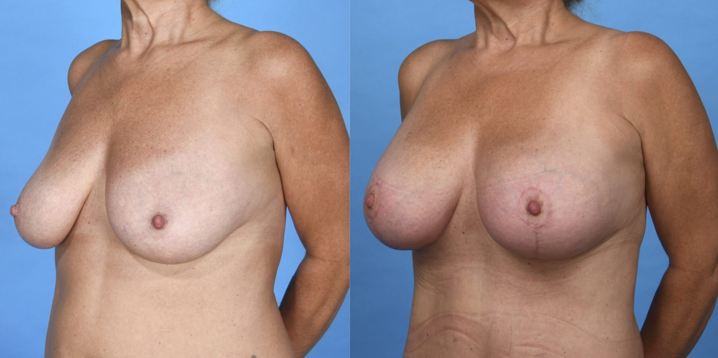 Before and After Image: Silicone Breast Augmentation Mastopexy - left-front-oblique