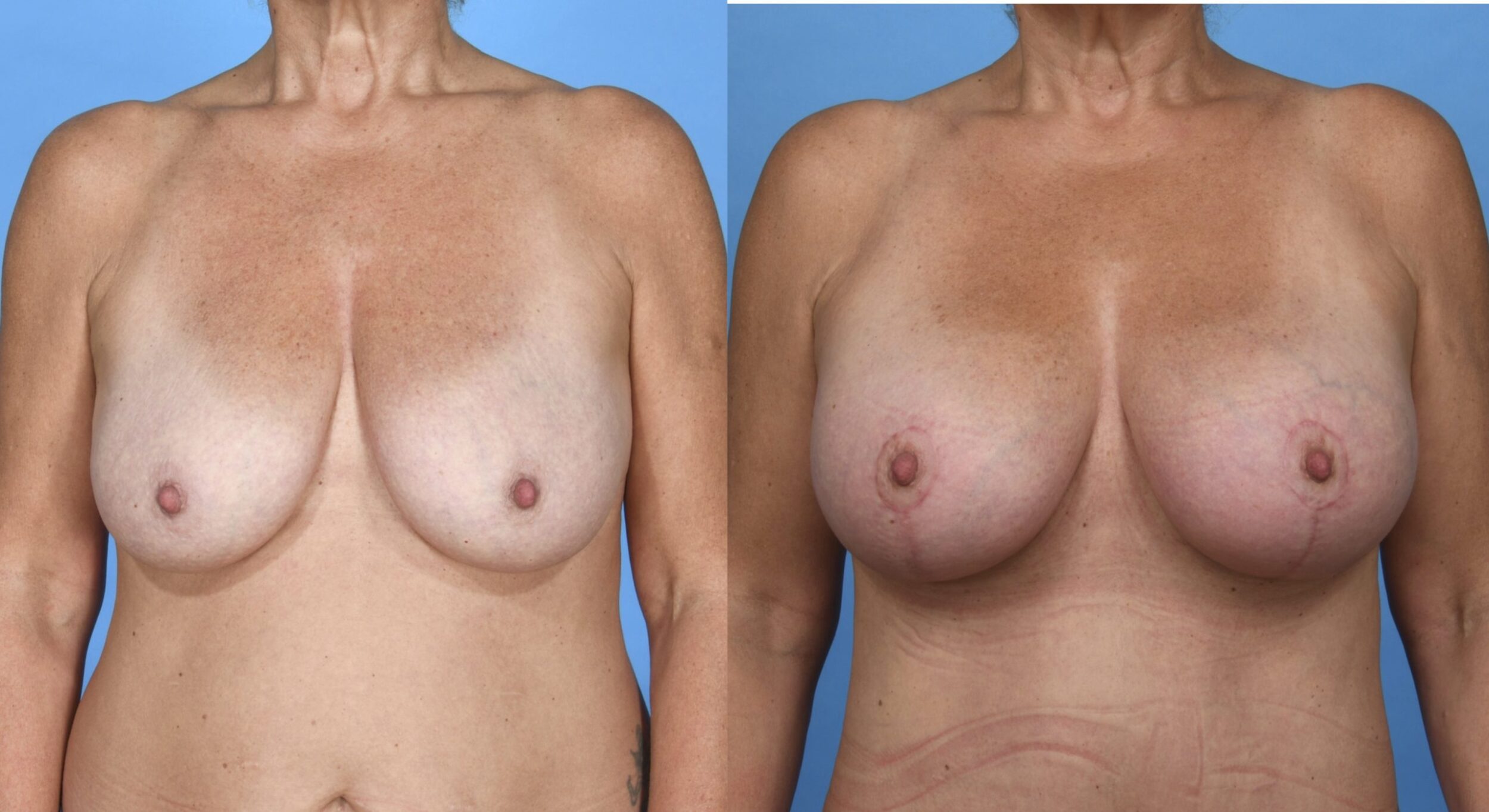 Before and After Image: Silicone Breast Augmentation Mastopexy - front