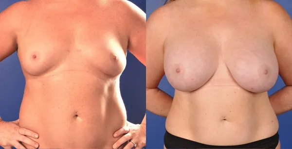 Before and After Image: Subfascial Silicone Breast Augmentation with Internal Mesh support - front
