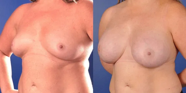 Before and After Image: Subfascial Silicone Breast Augmentation with Internal Mesh support - left-front-oblique