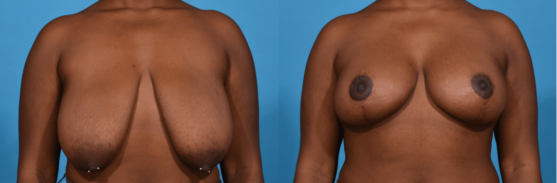 Before and After Image: Breast Reduction - front