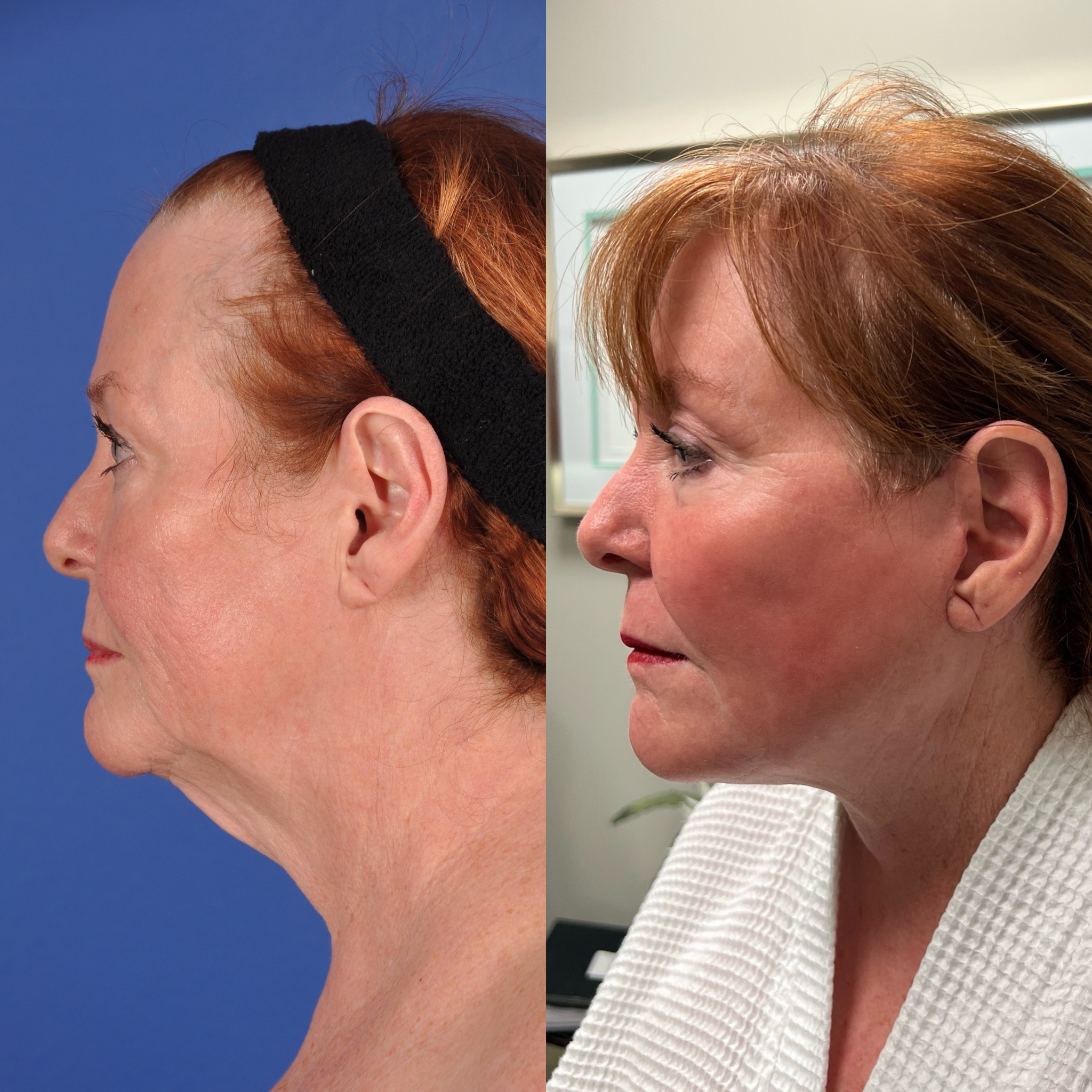 Before and After Image: Neck Lift - left-side