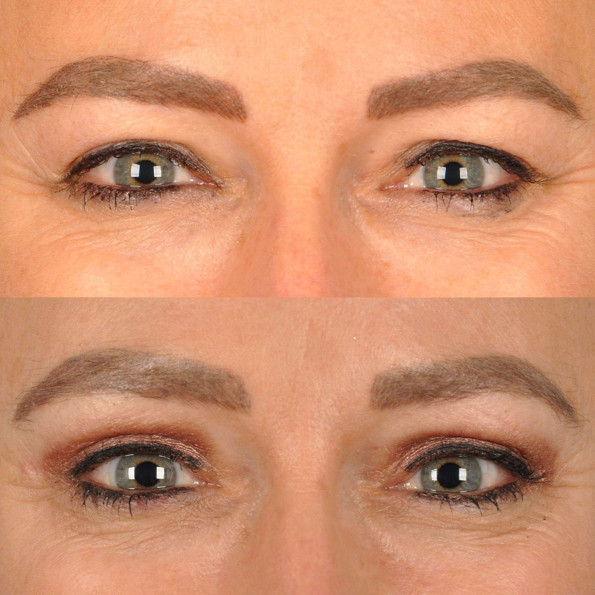 Before and After Image: Blepharoplasty - front