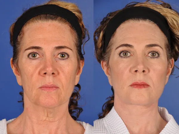 Before and After Image: Facial Rejuvenation - front