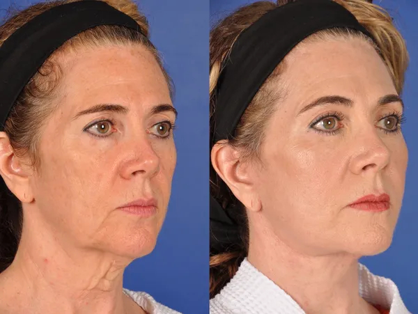 Before and After Image: Facial Rejuvenation - right-front-oblique