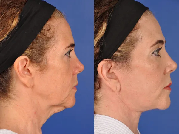 Before and After Image: Facial Rejuvenation - right-side