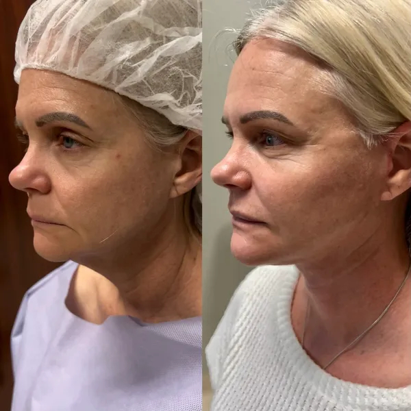 Before and After Image: Facial Fat Grafting and Lower Face/Neck Lift - left-front-oblique