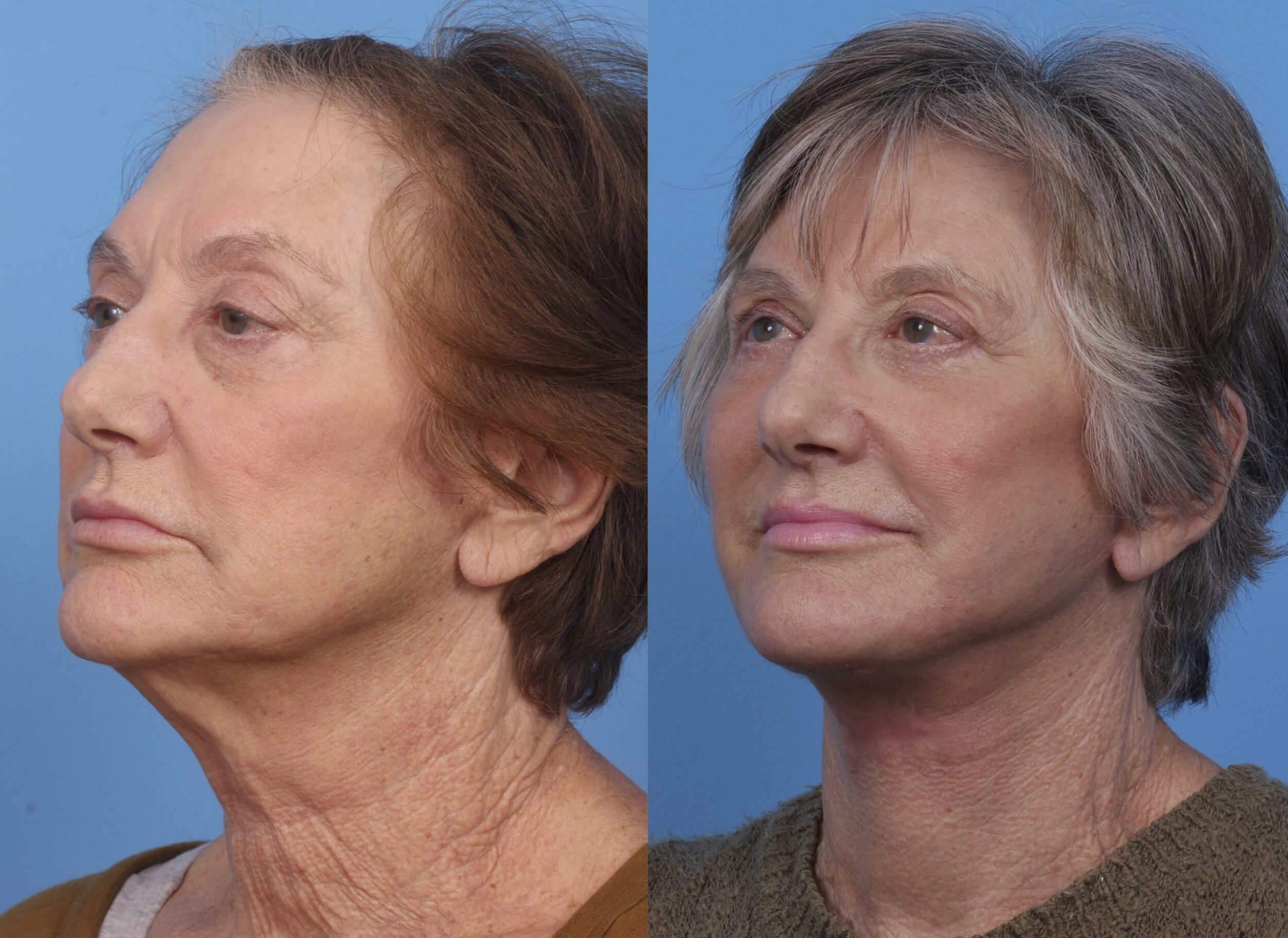 Before and After Image: Facial Rejuvenation - left-front-oblique