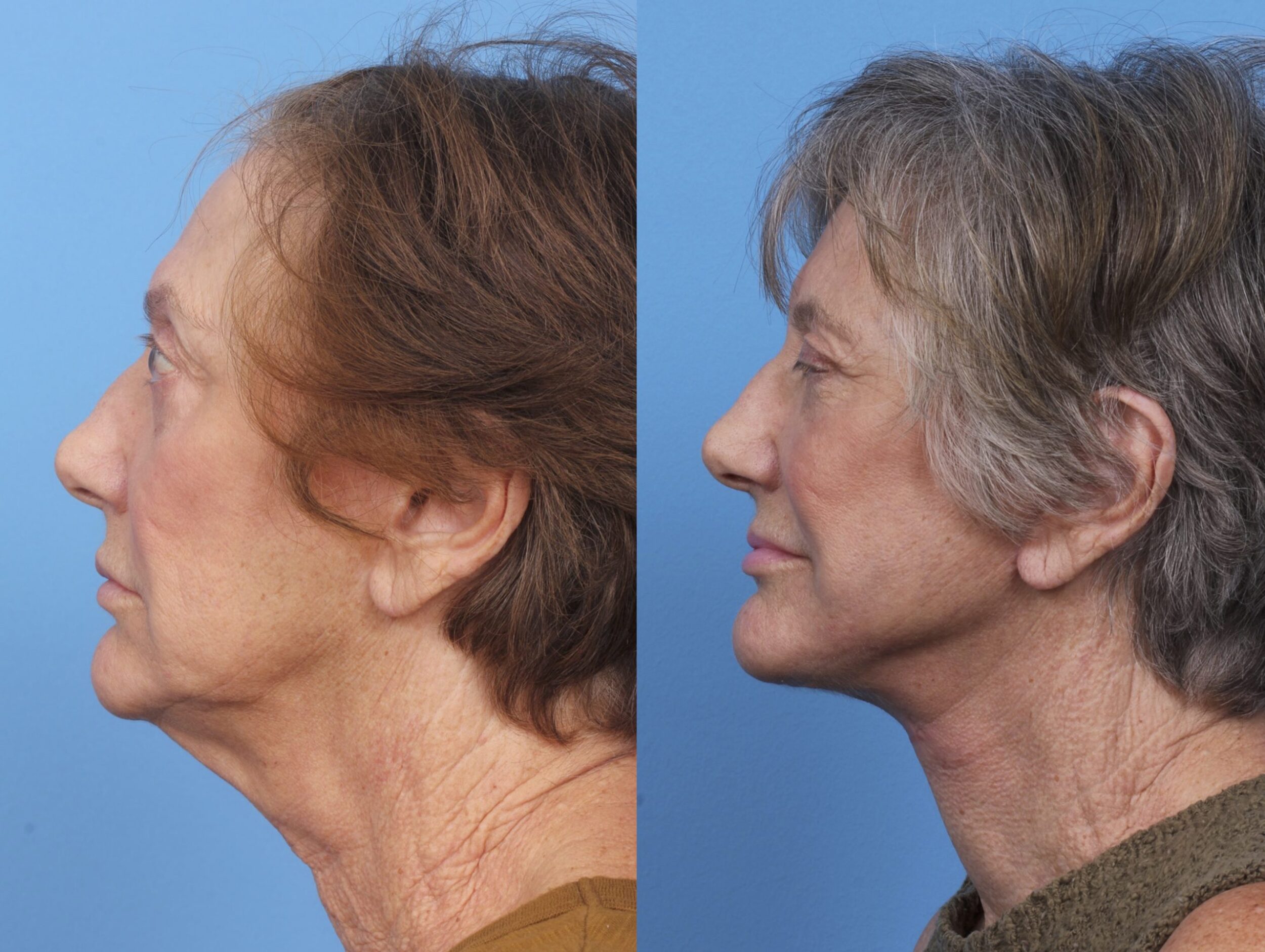 Before and After Image: Facial Rejuvenation - left-side