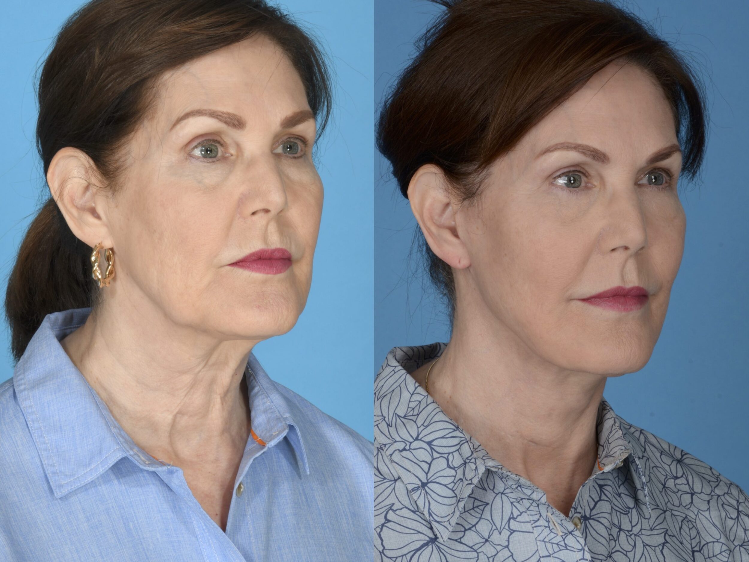 Before and After Image: Facial Rejuvenation - front