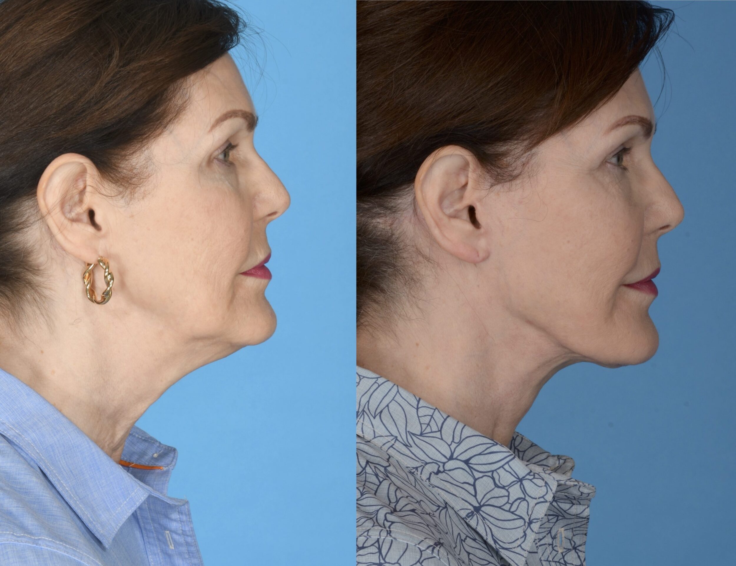 Before and After Image: Facial Rejuvenation - right-side