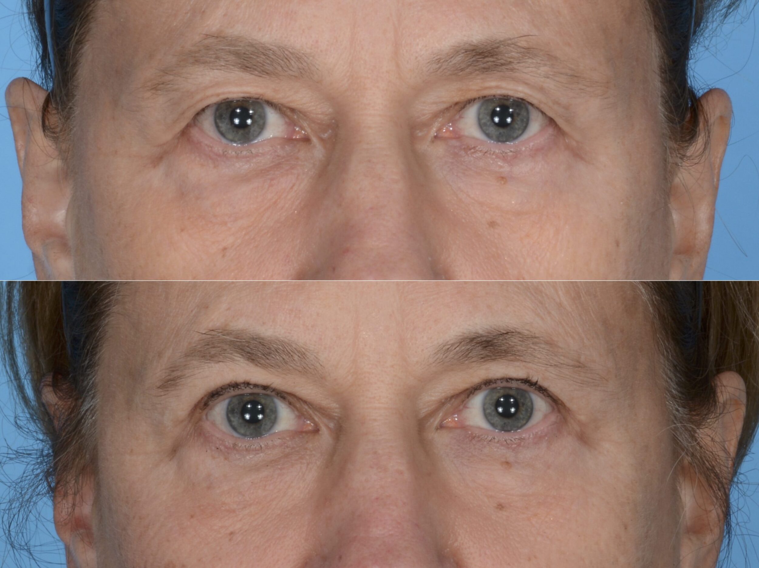 Before and After Image: Blepharoplasty - front