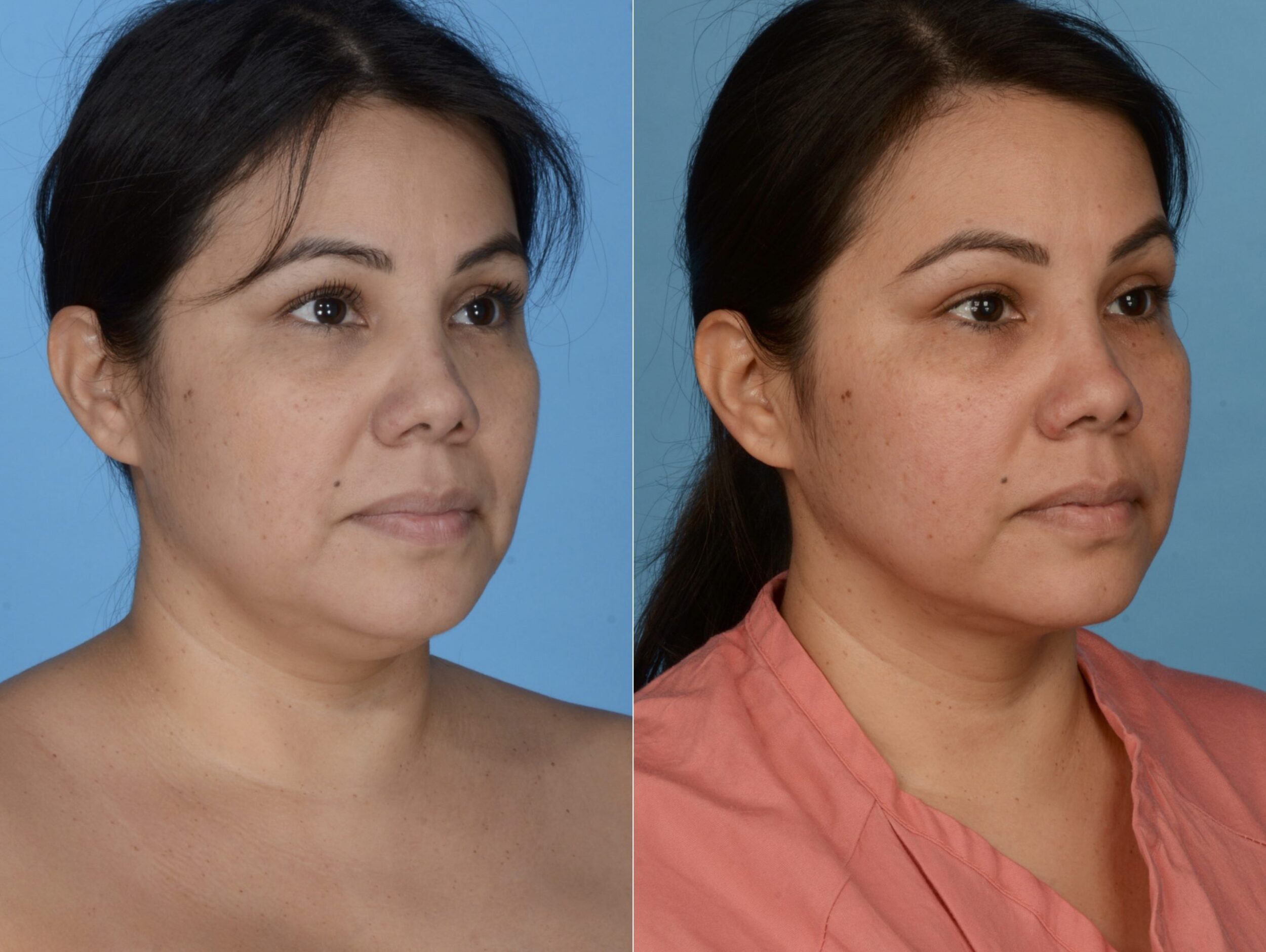 Before and After Image: Neck Liposuction and RF Skin Tightening - right-front-oblique