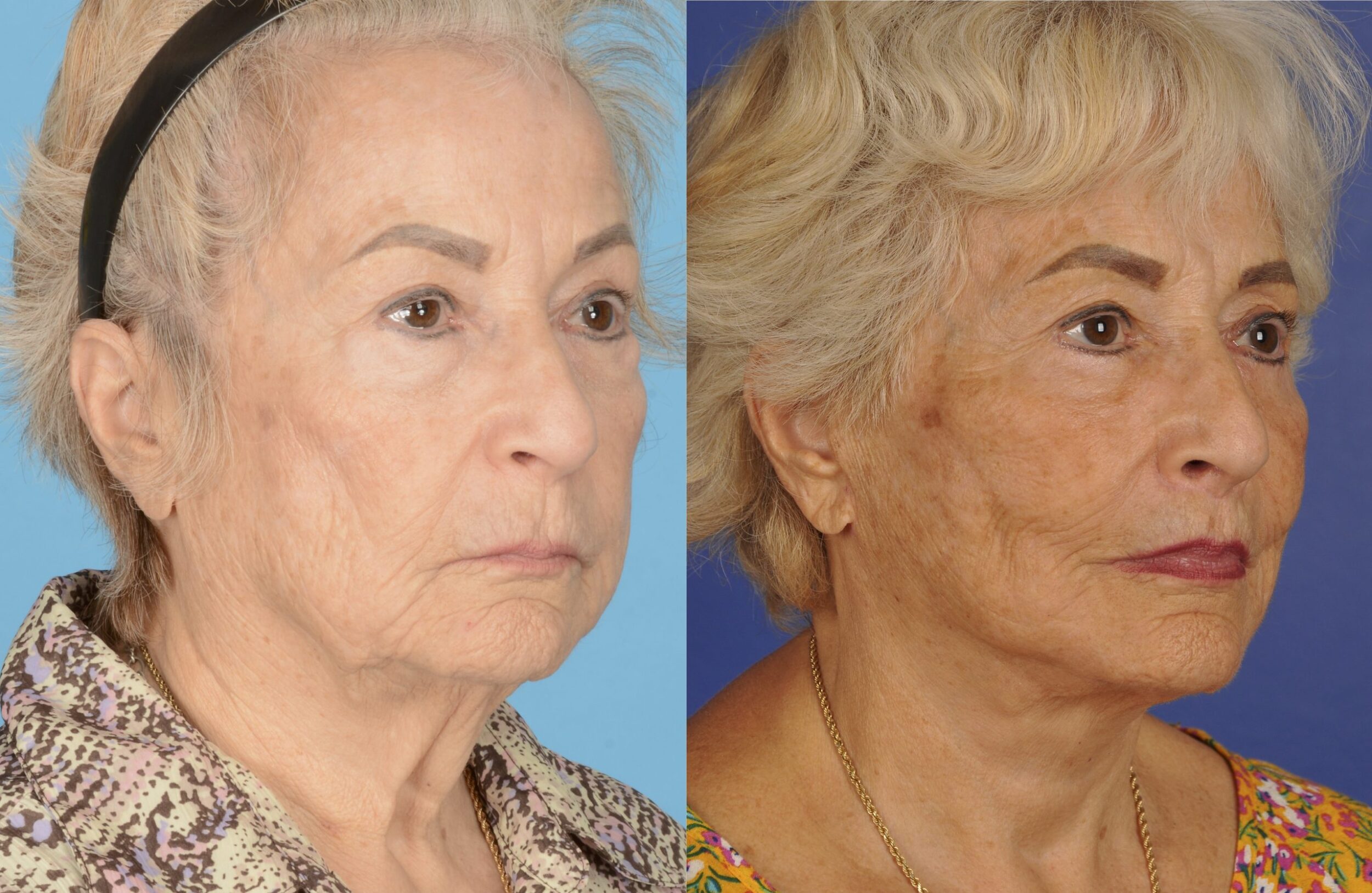 Before and After Image: Full Facial Rejuvenation - front
