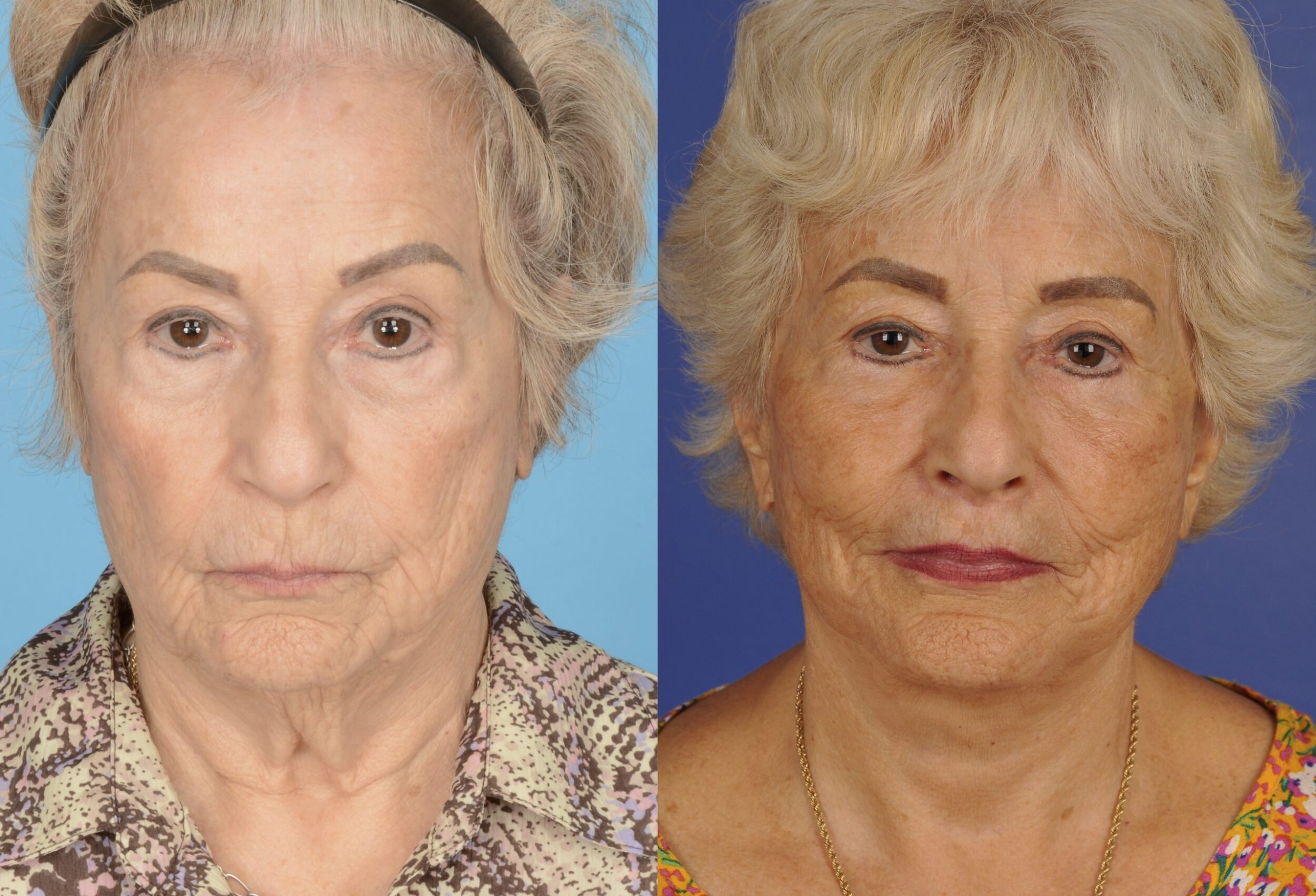 Before and After Image: Full Facial Rejuvenation - front